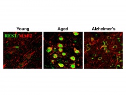 Induction of REST in aging human neurons. The transcriptional repressor REST, expressed at low levels in young adults (left), is induced in normal aging human neurons (center) and may protect against age-related stresses, including abnormal proteins associated with neurodegenerative diseases.  REST is lost in critical brain regions in the early stages of Alzheimer's disease (right), which may predispose to cognitive decline.
