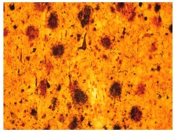 This brain section imaged with a silver stain shows the pathology of Alzheimer’s disease.  A major challenge is to find therapeutic interventions that prevent these changes and preserve cognitive function during aging.