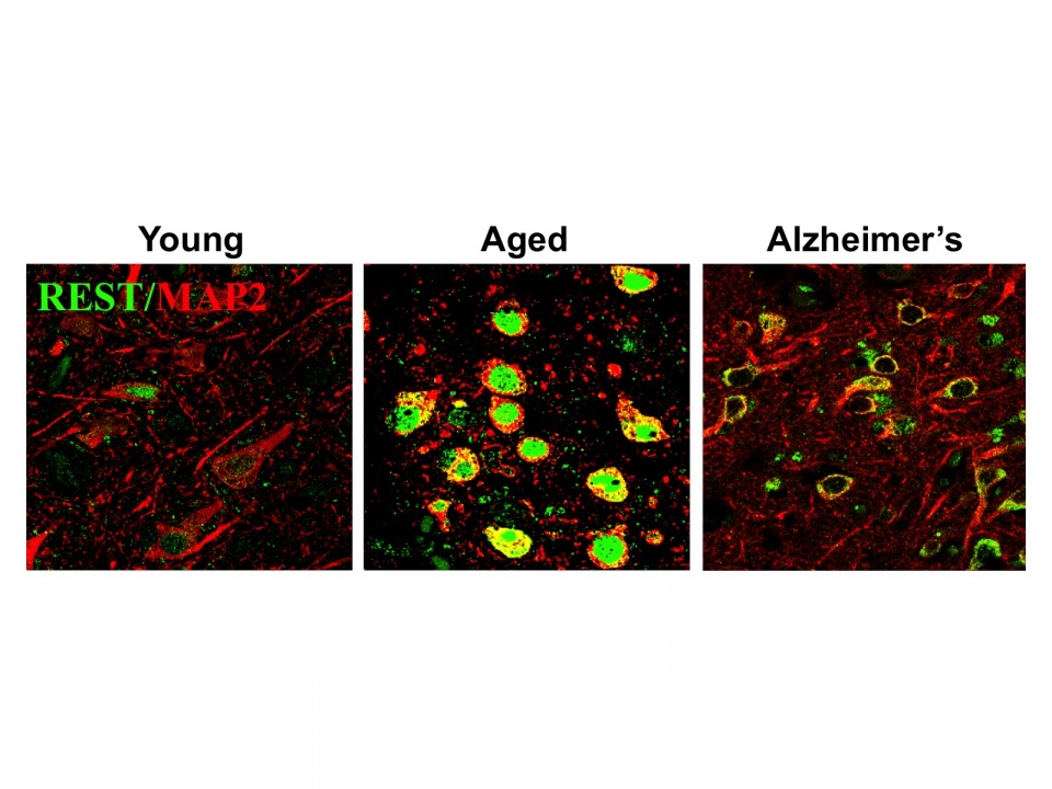 Induction of REST in aging human neurons. The transcriptional repressor REST, expressed at low levels in young adults (left), is induced in normal aging human neurons (center) and may protect against age-related stresses, including abnormal proteins associated with neurodegenerative diseases.  REST is lost in critical brain regions in the early stages of Alzheimer's disease (right), which may predispose to cognitive decline.